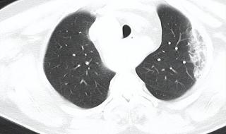 呼吸衰竭的临床表现 呼吸衰竭最早出现的症状是什么